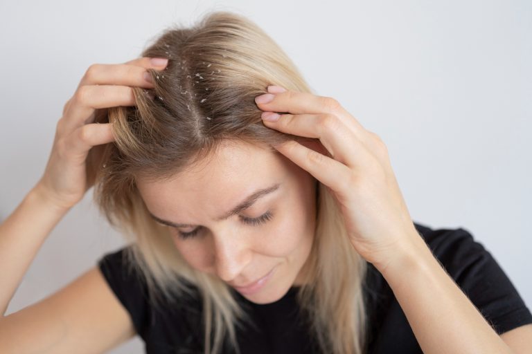 close up woman with dandruff
